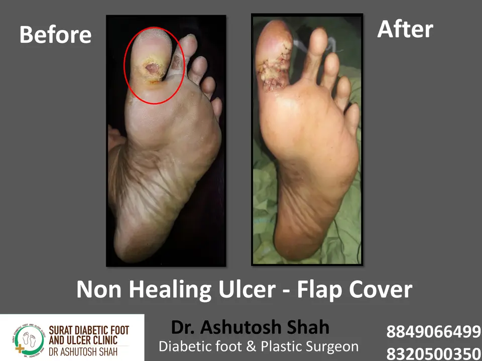 Diabetic Foot  PPT 3 checked by sir.pptx-69.webp